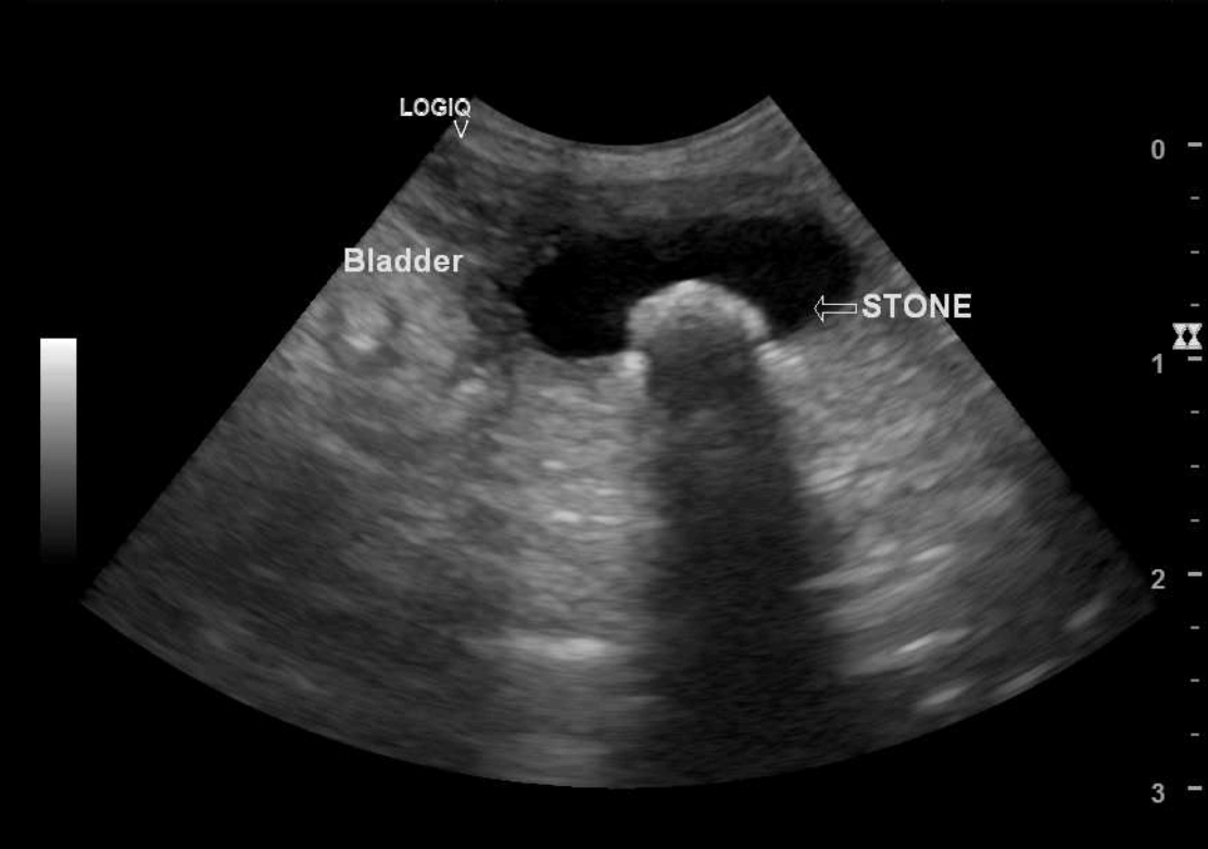 Ultrasound of Bladder with stone